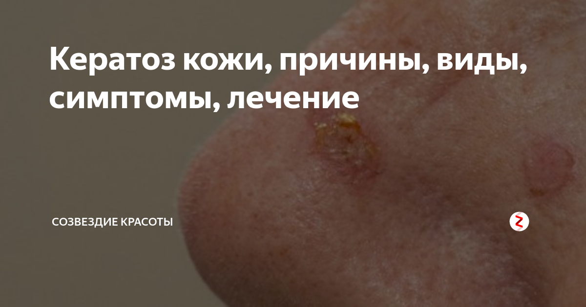 Кератоз кожи, причины, виды, симптомы, лечение | Созвездие красоты | Дзен