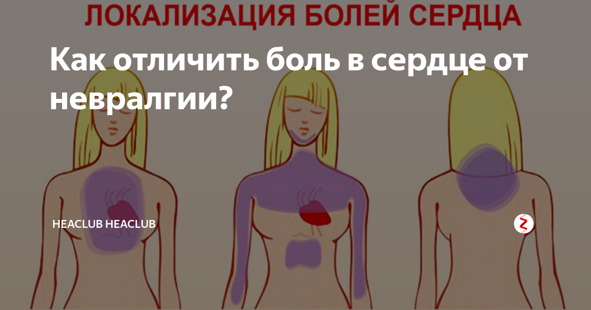 Как болит сердце симптомы у женщин. Локализация боли в сердце. Как отличить боль в сердце. Невралгия в области сердца. Невралгия в области сердца симптомы.