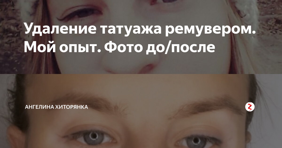 Удаление татуажа ремувером. Мой опыт. Фото до/после | Ангелина ...