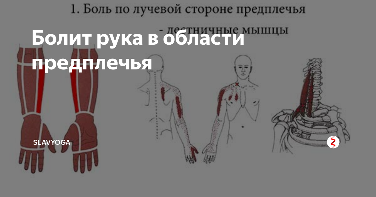 Болит левая рука от плеча. Боль в предплечье правой. Боль в мышце предплечья правой руки. Боль в предплечье левой руки.