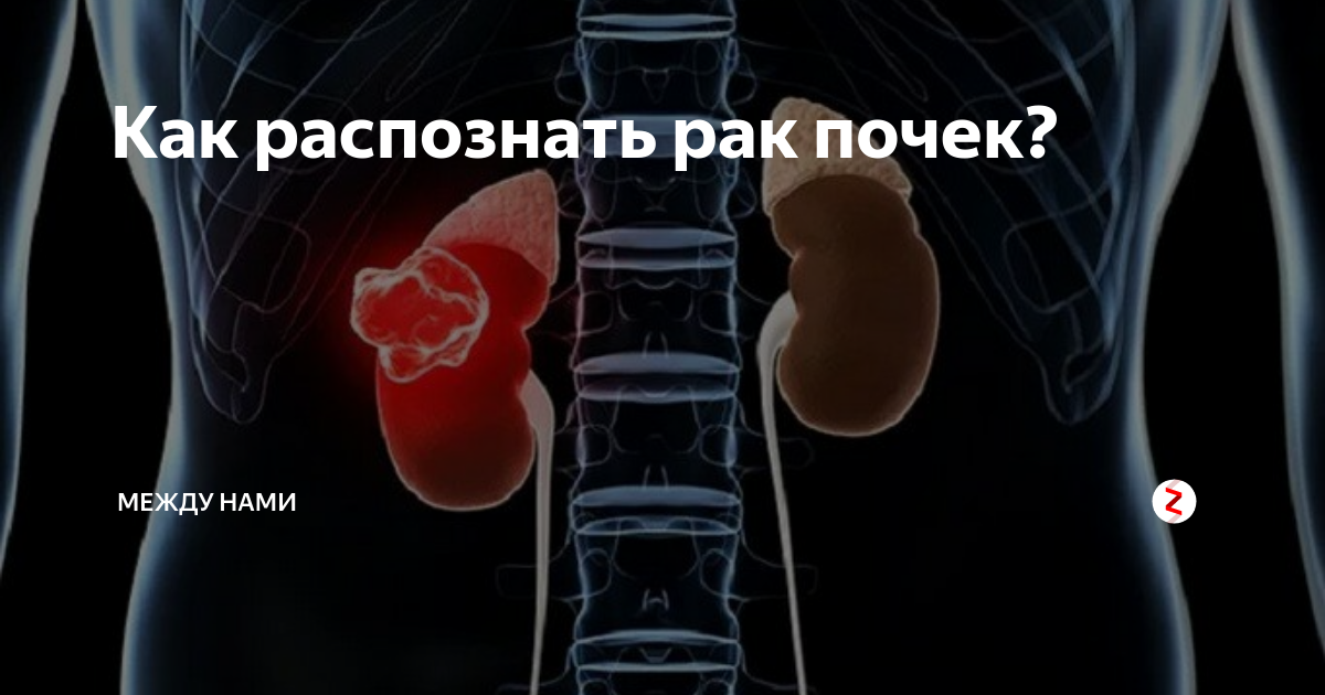 ранний признак опухоли почки. злокачественные опухоли почки классификация. онкология почки симптомы и признаки болезни у женщин. симптомы при опухоли почки. доброкачественные новообразования почек.