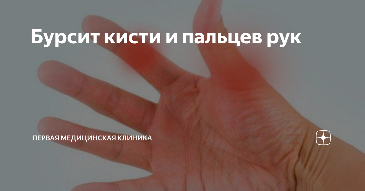 Хронический бурсит с отложение кальция. Бурсит - Лечение в Москве | Лечение, Бурса Suprapatellar bursitis of the knee joint - symptoms and treatment. Отложение солей в суставах [лечения, симптомы и диагностика]
