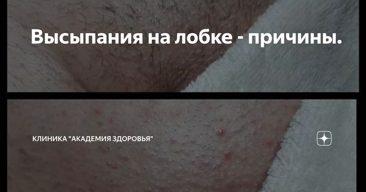 Высыпания на лобке - причины. | Гесклиник | Дзен