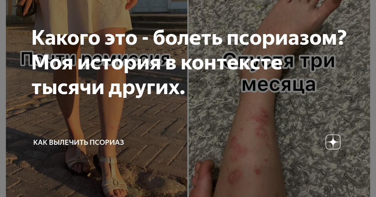 Какого это - болеть псориазом? Моя история в контексте тысячи других ...