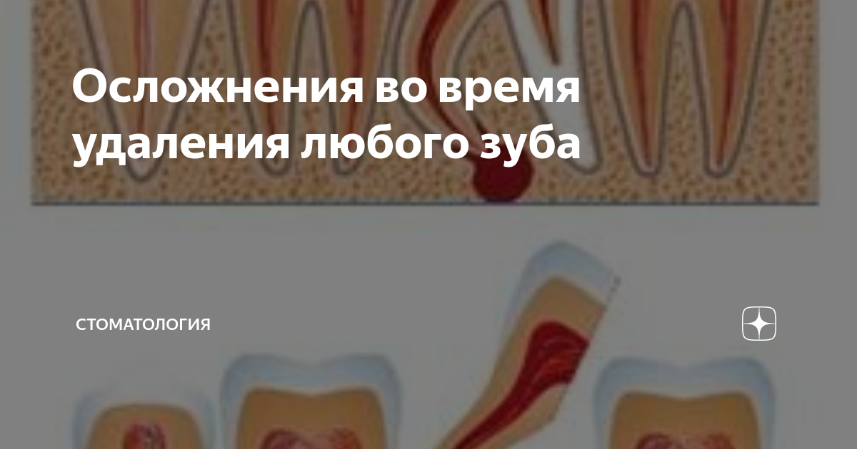 Осложнения во время удаления любого зуба | Стоматология | Дзен