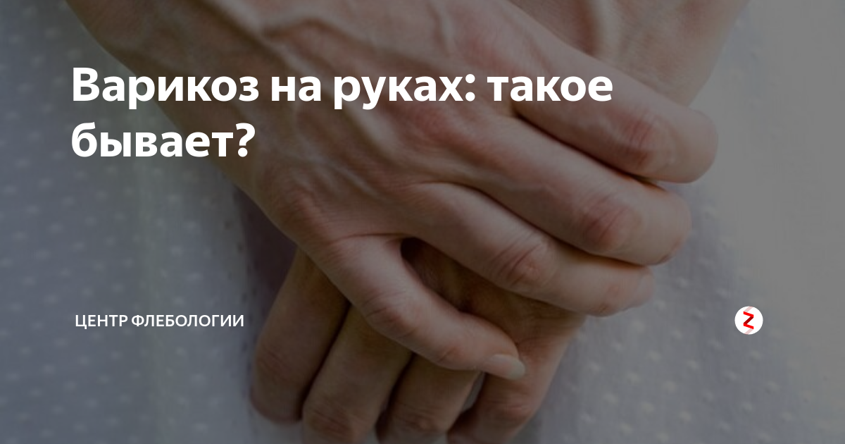 Варикоз на руках: такое бывает? | Центр Флебологии | Дзен