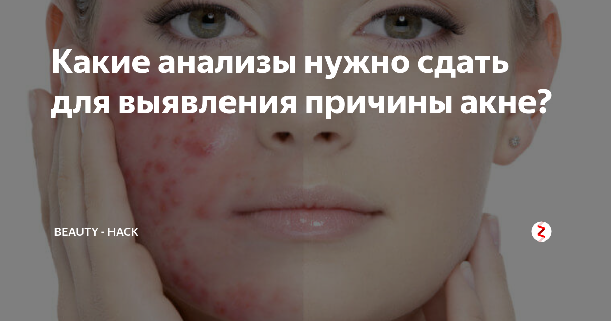 Какие анализы нужно сдать для выявления причины акне? | Медик вещает📢 ...