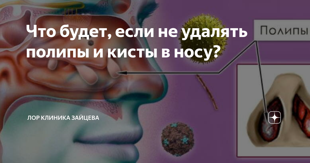 Что будет, если не удалять полипы и кисты в носу? | ЛОР КЛИНИКА ЗАЙЦЕВА ...