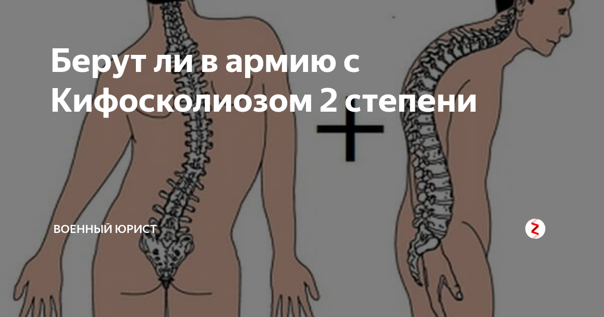 Степени сколиоза позвоночника армия. Кифосколиоз 1 степени армия. Искривление позвоночника армия.