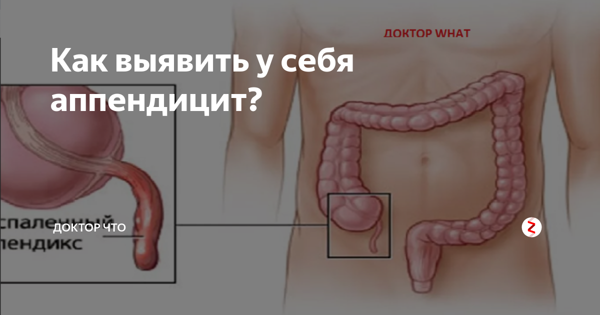 Аппендицит слева. Внутренние органы аппендицит. Расположение аппендицита у мужчин. Расположение аппендицита у человека схема. Аппендицит расположение у женщин