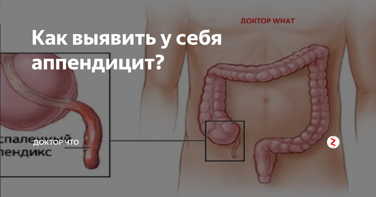 Аппендицит это. Внутренние органы аппендицит. Расположение аппендицита у мужчин. Расположение аппендицита у человека схема. Аппендицит расположение у женщин.