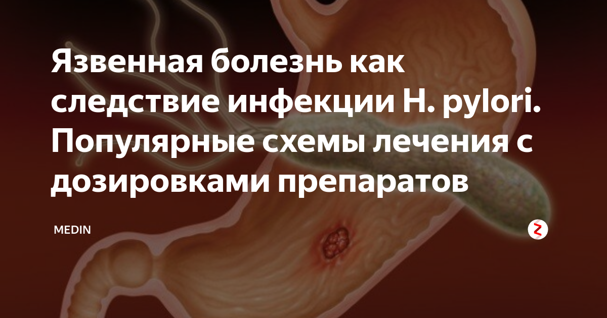 Язвенная Болезнь Как Следствие Инфекции H. Pylori. Популярные.