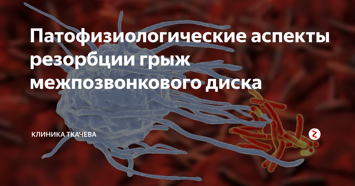 Что такое резорбция межпозвонковой грыжи. Резорбция грыжи межпозвонкового. Резорбция грыжи межпозвонкового диска. Метод резорбции в лечении межпозвоночной грыжи