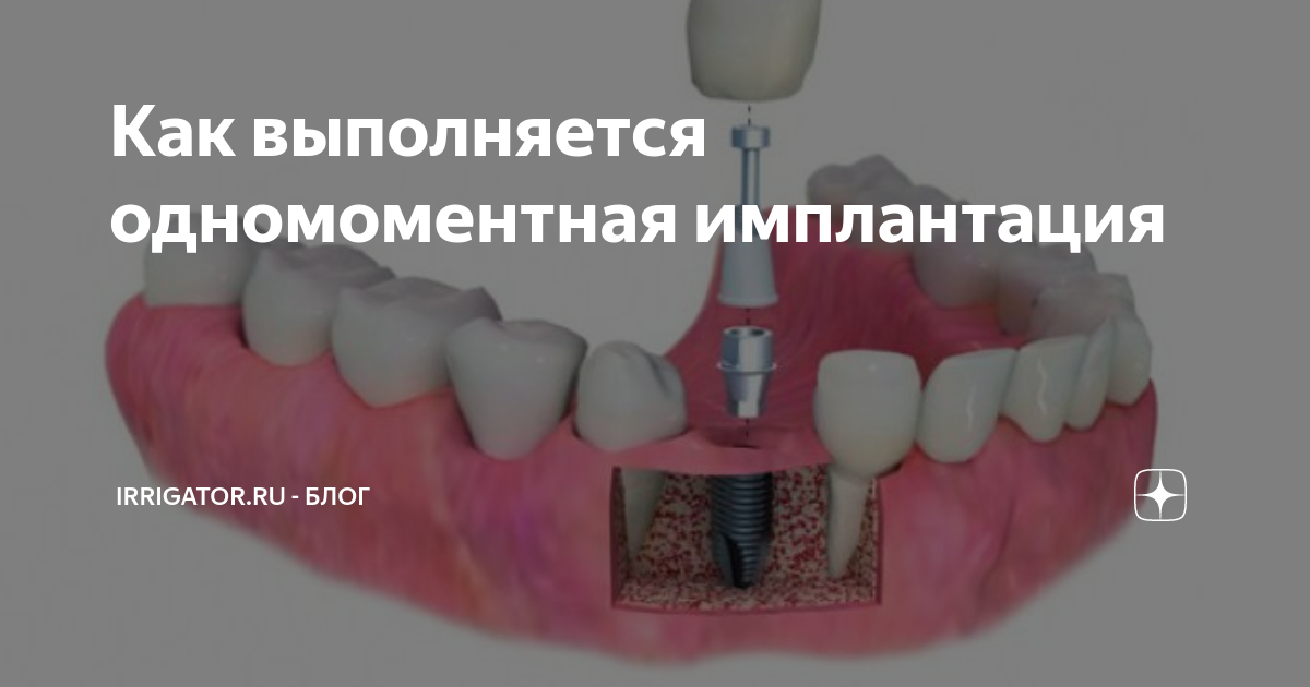 Одномоментная имплантация