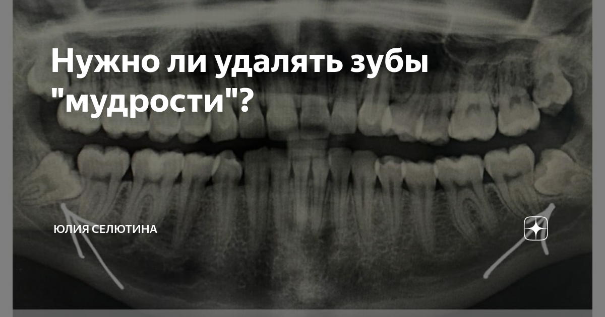 Удалить надо удалять. Удалённый зуб мудрости. Удаленные зубы мудрости.