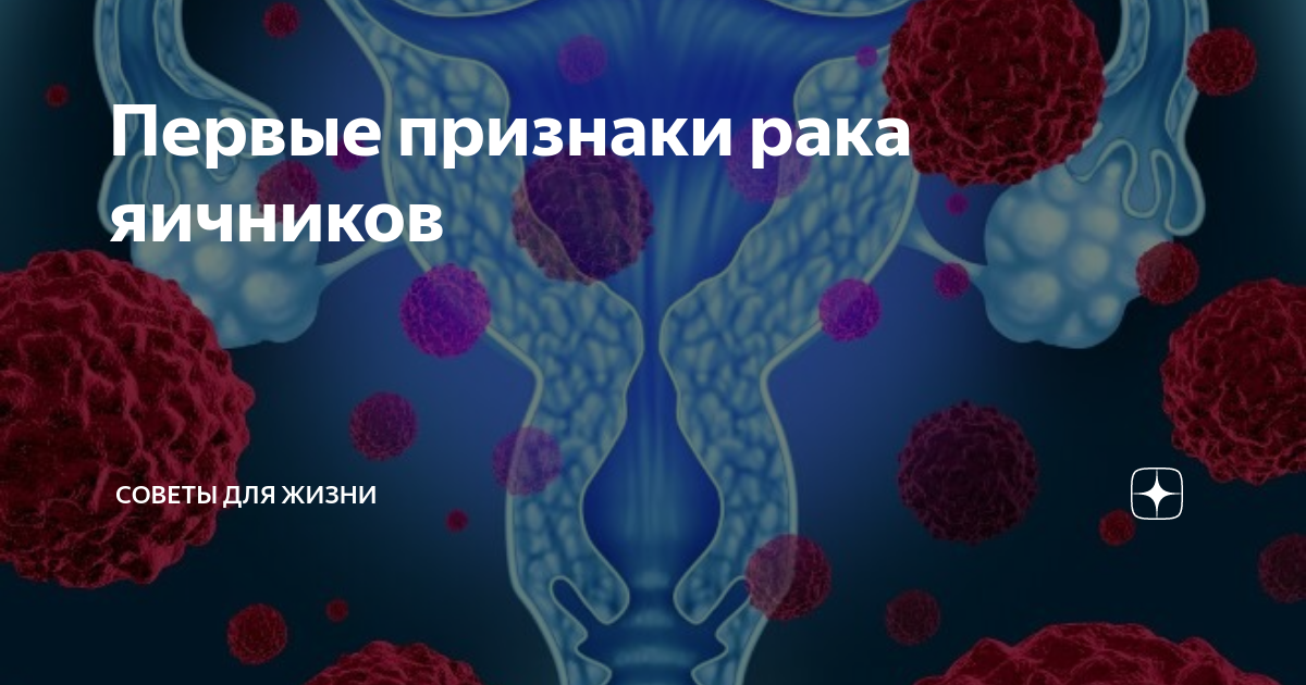 Симптомы рака яичников. Предраковые заболевания яичников. Онкология матки и яичников симптомы. Признаки злокачественного поражения яичников. Карцинома яичника боли.