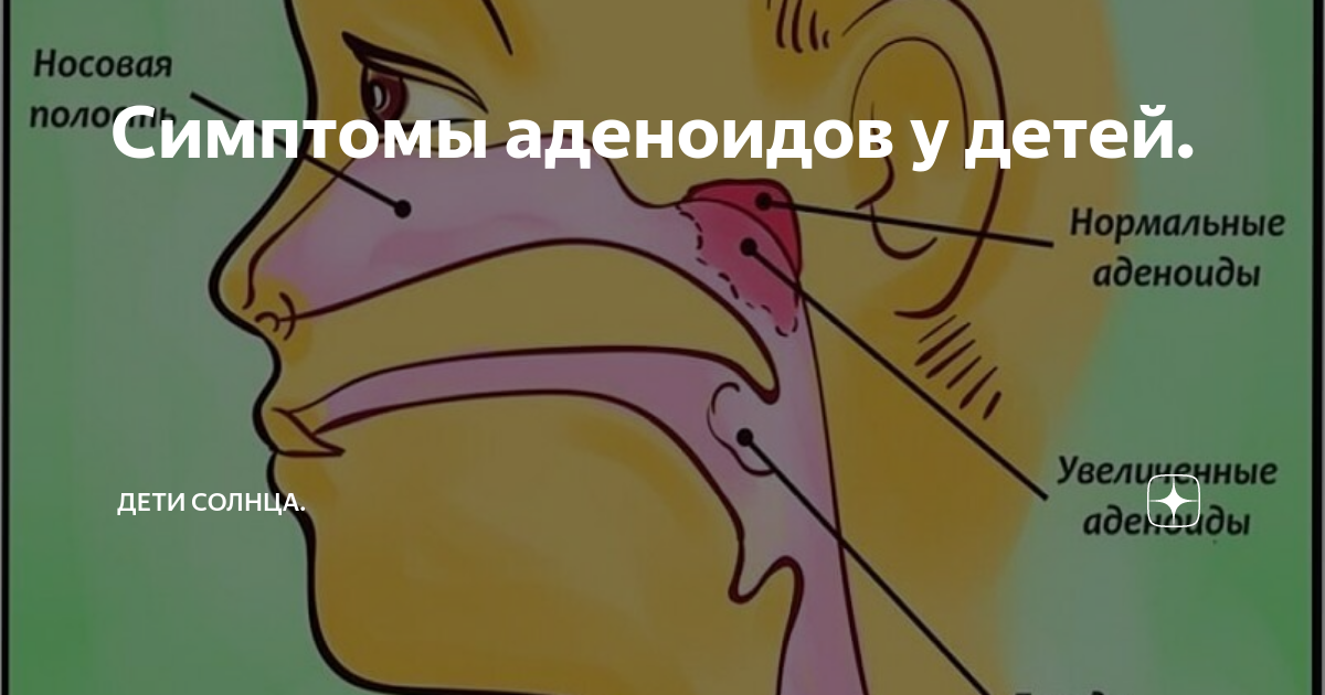 Симптомы аденоидов у детей 5
