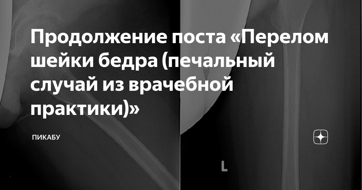 Продолжение поста «Перелом шейки бедра (печальный случай из врачебной ...