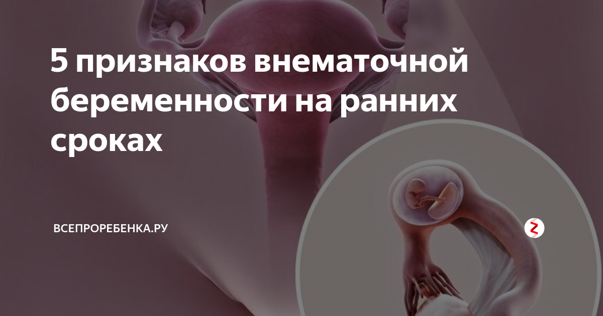 Внематочная беременность симптомы на ранних. Внематочная беременность симптомы. Критерии внематочной беременности. Внематочная беременность на ранних сроках. Внематочная беременность симптомы на ранних сроках.