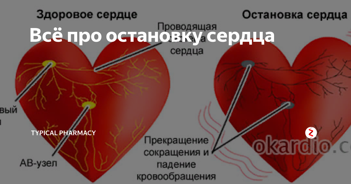 Краткие остановки сердца