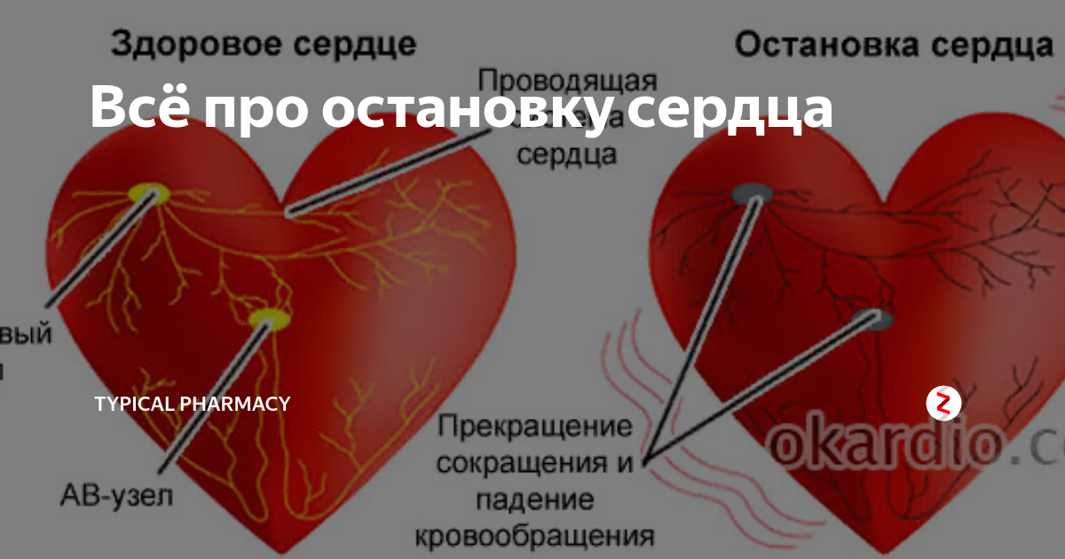 Проект остановка сердца