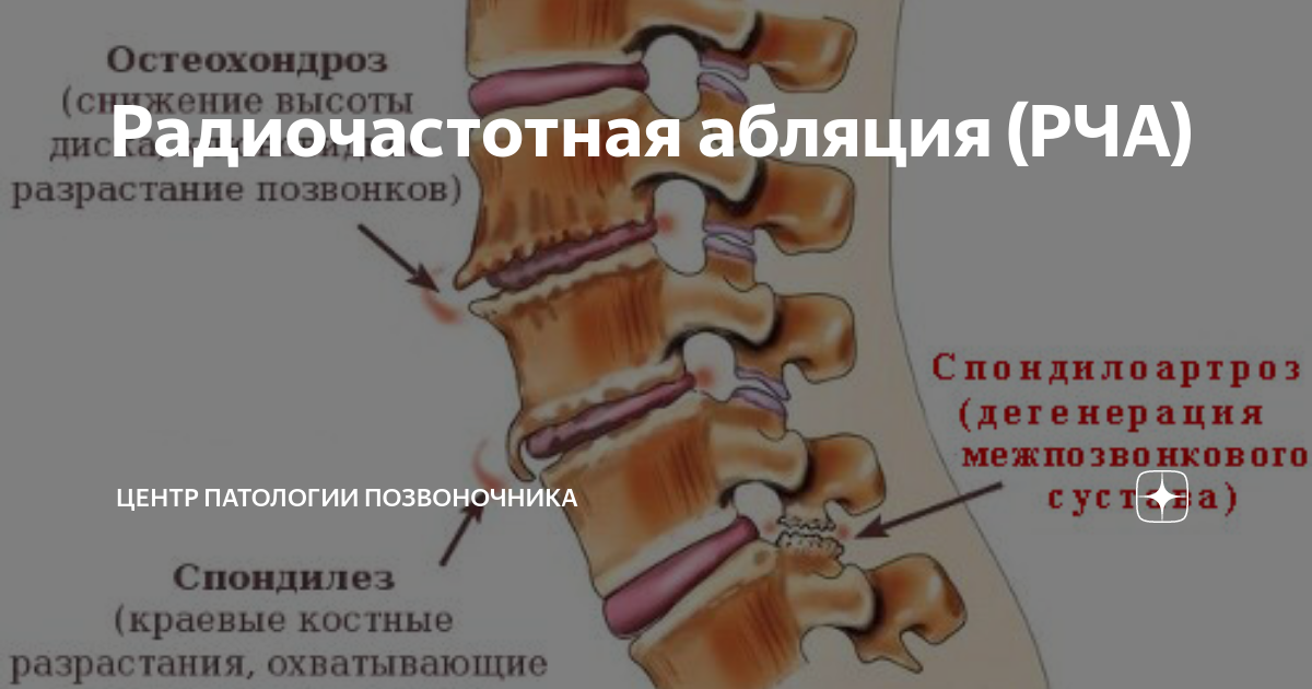 РАДИОЧАСТОТНАЯ АБЛЯЦИЯ (RFA) ПРОЦЕДУРА