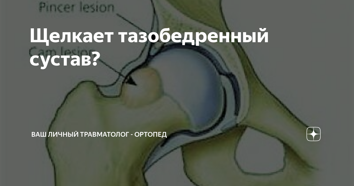 Щелкает тазобедренный сустав при ходьбе. Тимпанальный отосклероз. Кохлеарная форма отосклероза. Отосклероз гистология. Фенестральный отосклероз.