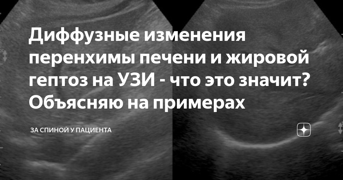 Диффузные изменения печени что это означает. Диффузные изменения печени что это означает