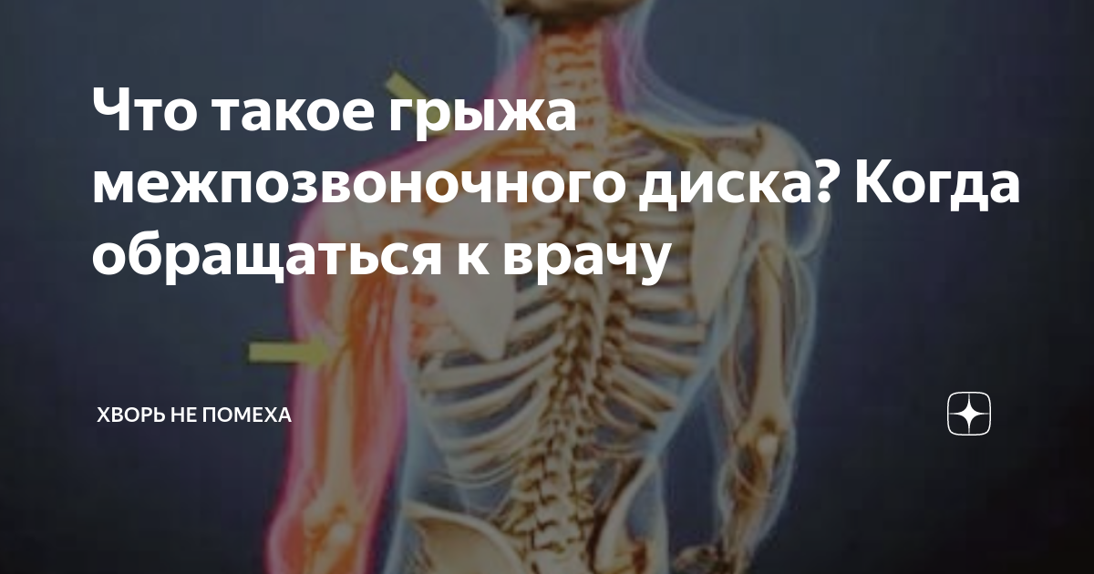 Что такое грыжа межпозвоночного диска? Когда обращаться к врачу | Хворь ...