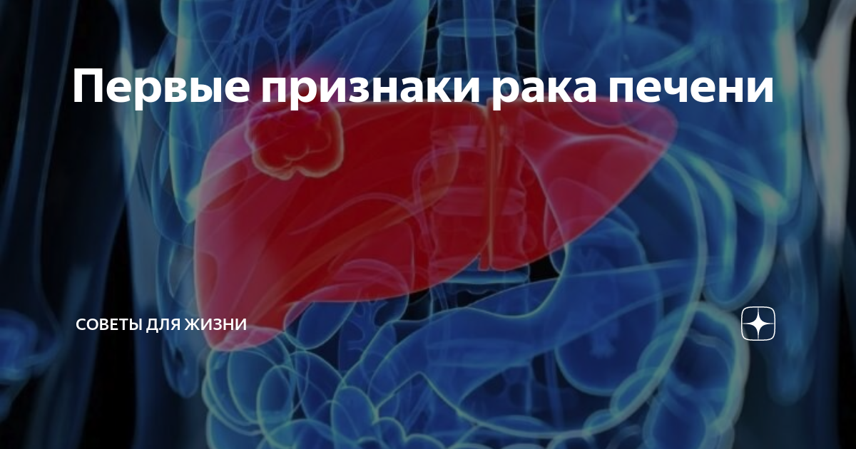 Рак печени 4 стадии сколько живут. Опухоль печени симптомы. Первые признаки онкологии печени. Первые симптомы онкологии печени. Онкология печени симптомы.