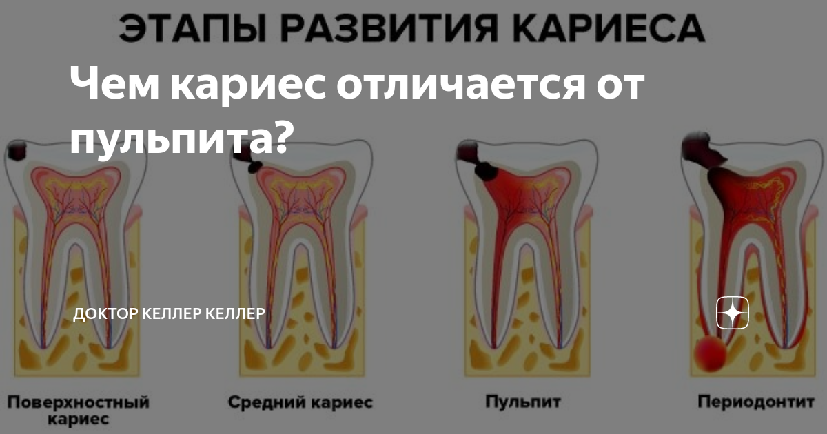 Цены на лечение кариеса в стоматологии Нуримед в Василеостровском районе