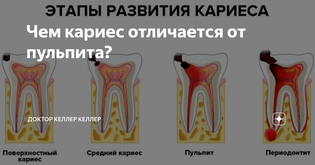 Пульпит и кариес отличия