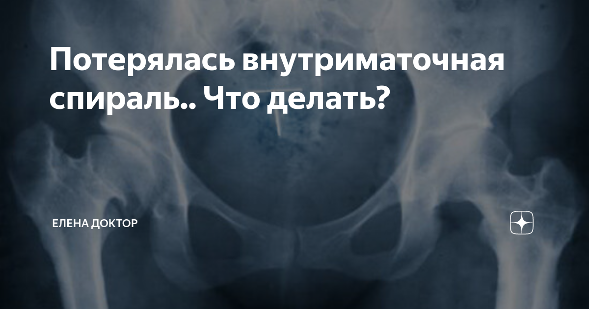 Спираль Мирена — 11 ответов гинеколога на вопрос № | СпросиВрача