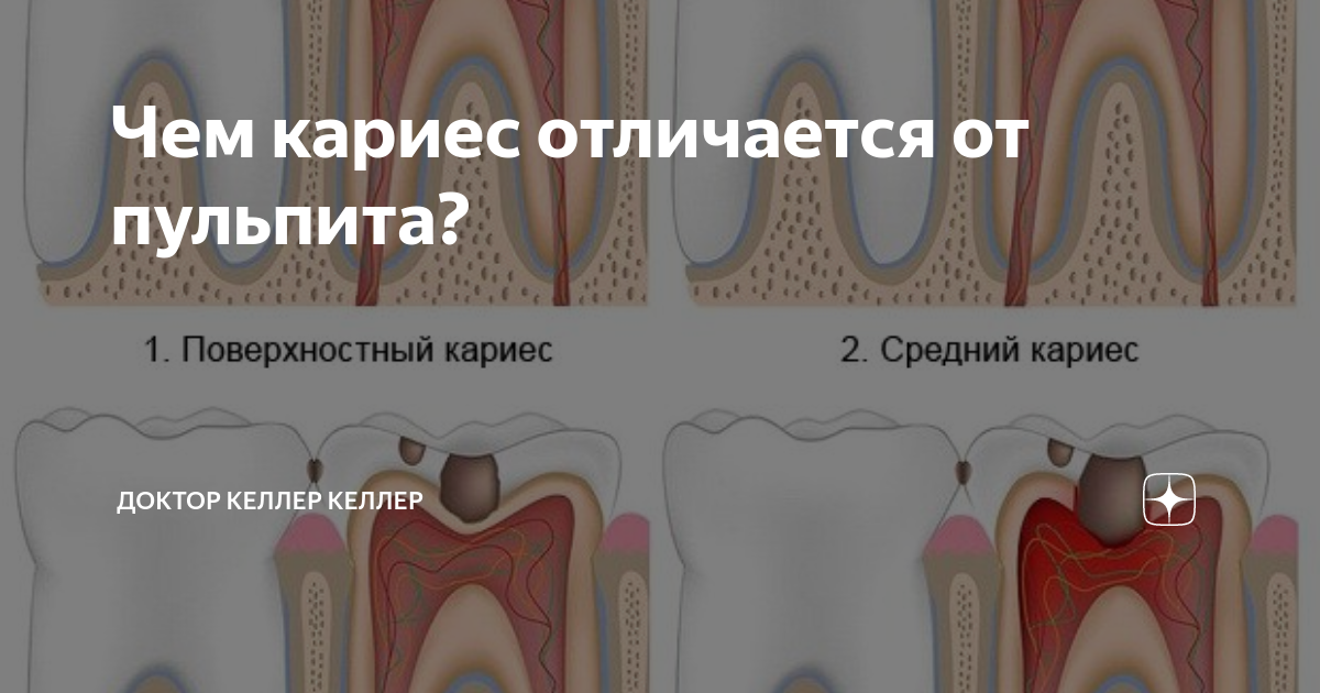 Чем отличается кариес от пульпита. Кариес и пульпит разница. Глубокий кариес пульпит. Как отличить пульпит от кариеса. Глубокий кариес и пульпит отличия.