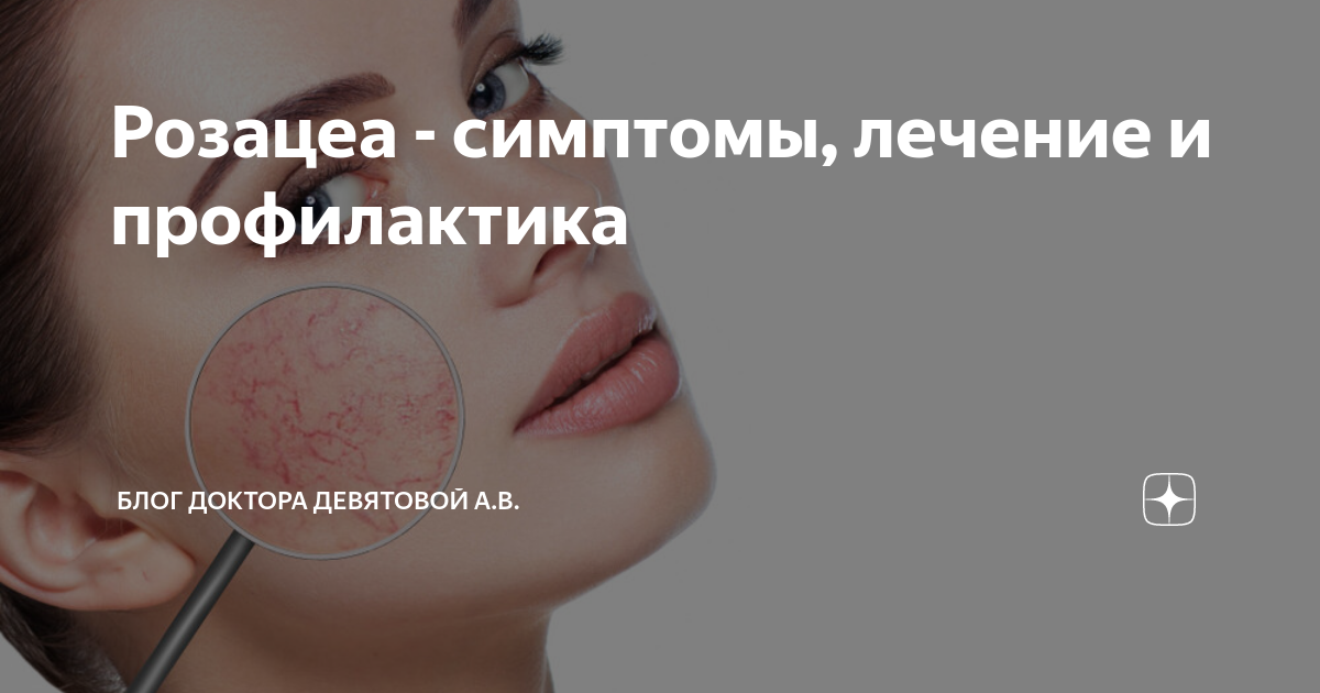Розацеа - симптомы, лечение и профилактика | Блог доктора Девятовой А.В ...