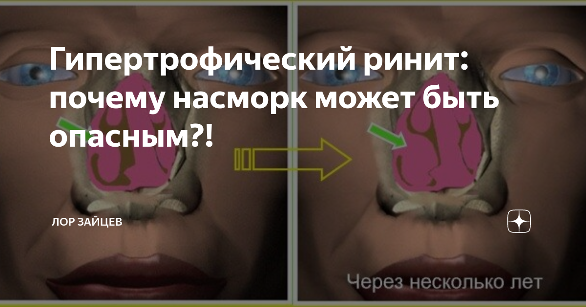 Почему насморк летом