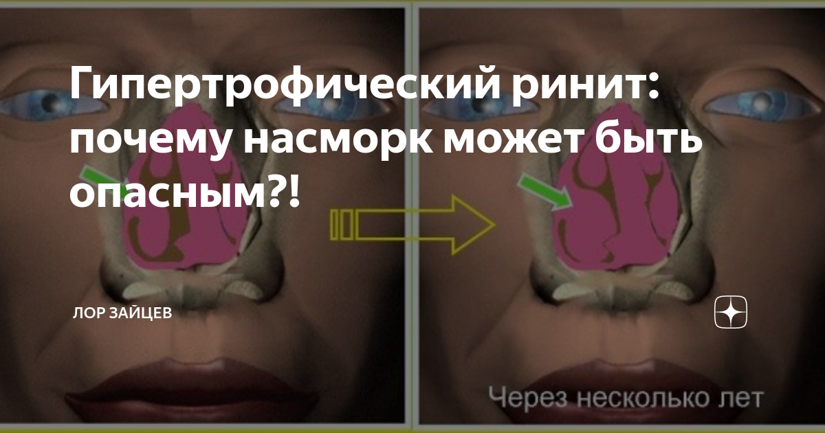 Почему насморк летом. Отсутствие одной из половин носа. Гипертрофический ринит операция эффективность.