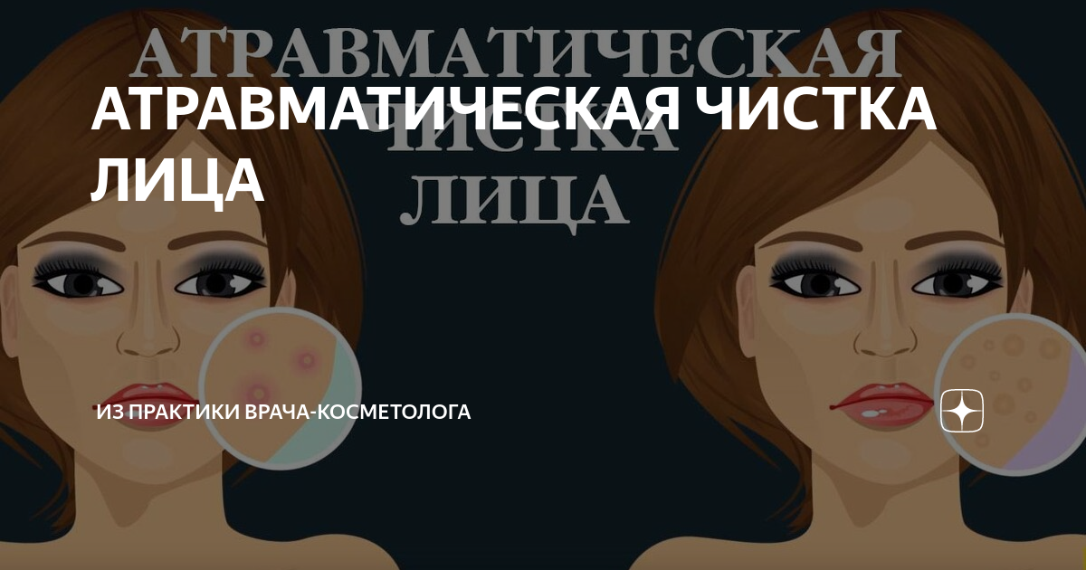 АТРАВМАТИЧЕСКАЯ ЧИСТКА ЛИЦА | Врач-дерматолог Юлиана Шиян | Дзен