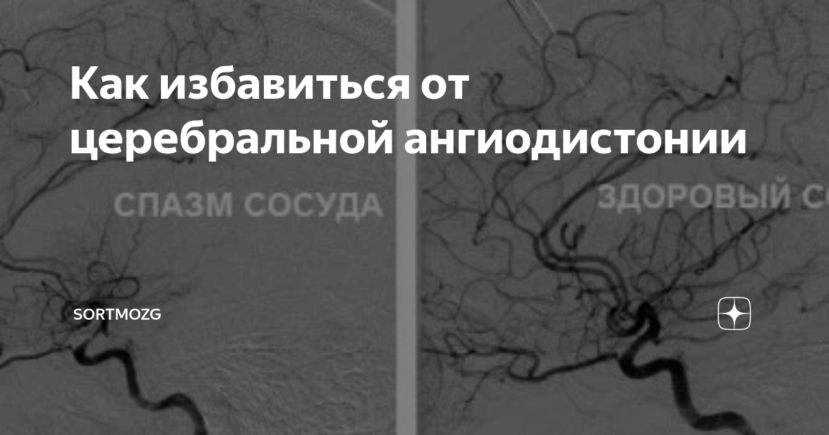 Церебральная ангиодистония что это