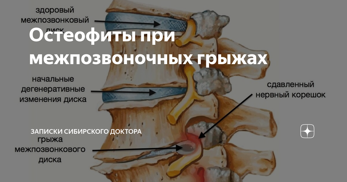 Остеофиты позвоночника