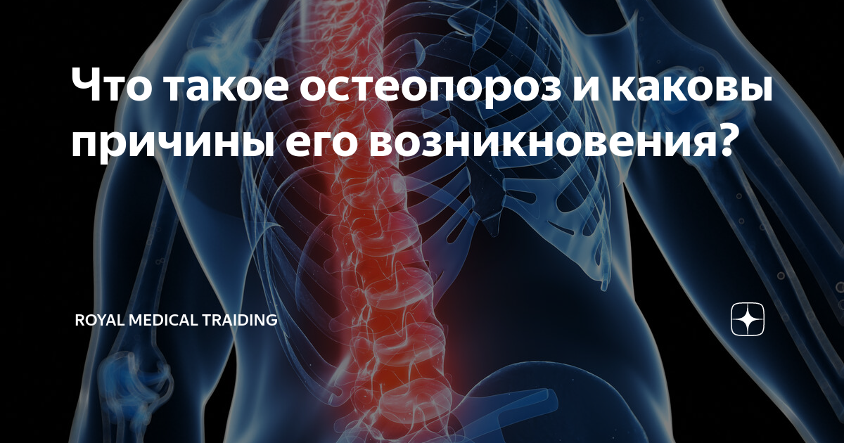 Что такое остеопороз и каковы причины его возникновения? | Royal ...