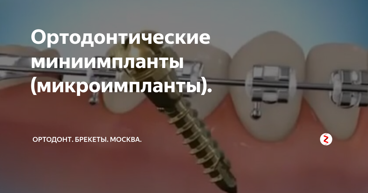 Микроимпланты в ортодонтии презентация