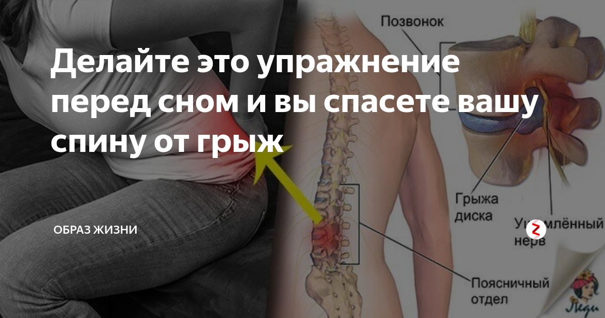 После грыжи можно бегать. Межпозвоночная грыжа седалищного нерва. Упражнения для седалищного нерва. Упражнение для поясницы и седалищного нерва. Нерв в пояснице.