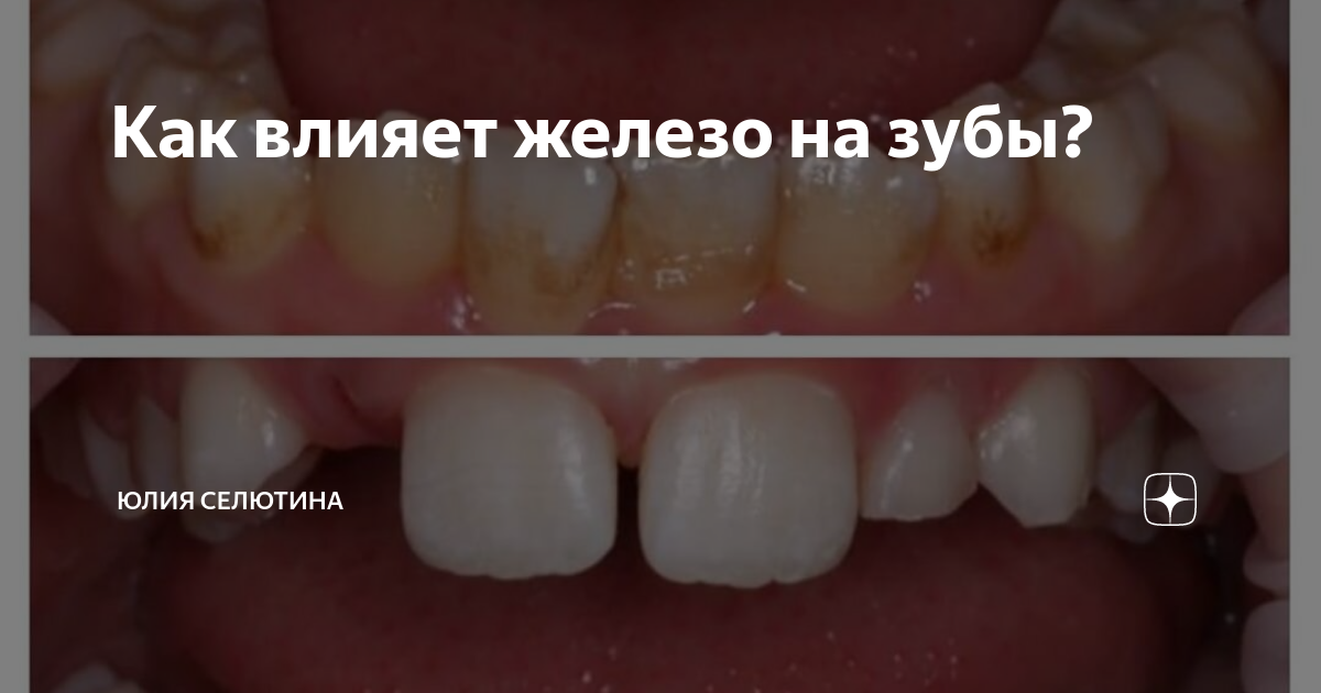 Препараты железа портят зубы