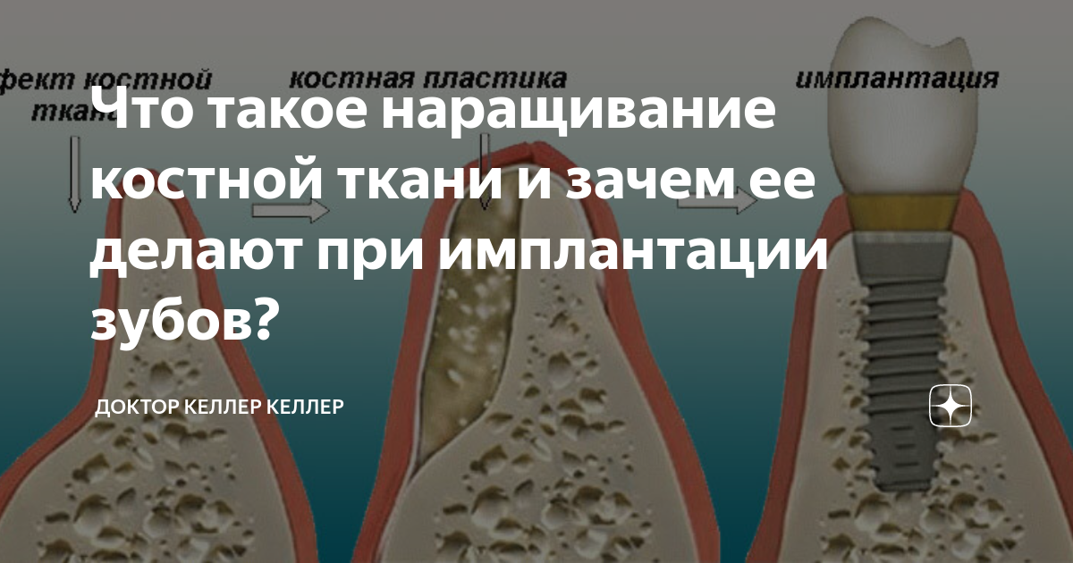 Имплантация при атрофии костной ткани челюсти
