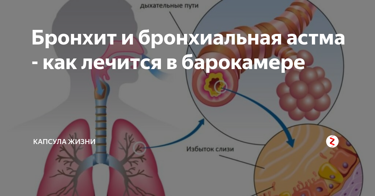 Астма бронхит лечение