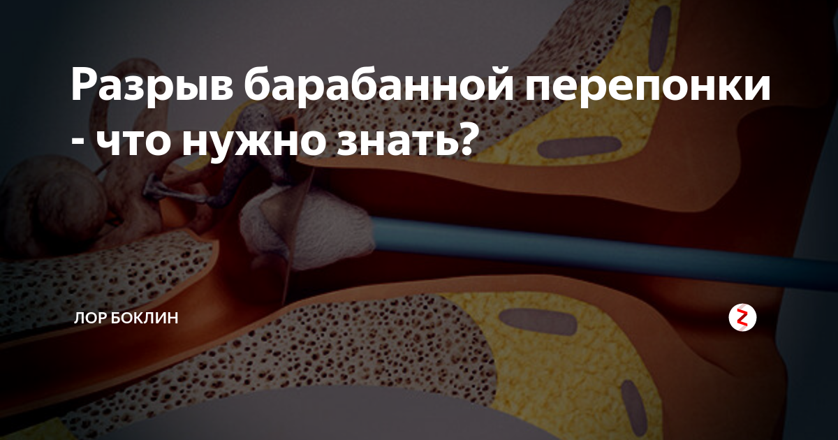 Разрыв барабанной перепонки - что нужно знать? | ЛОР Боклин | Дзен