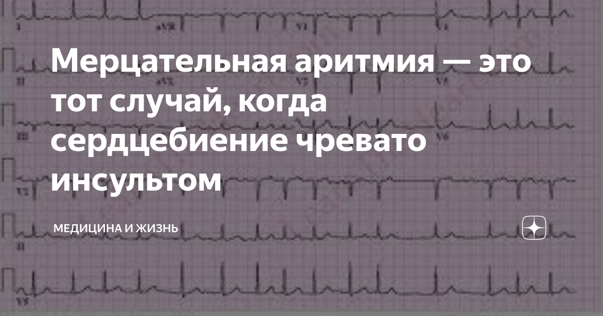 Мерцательная аритмия. Мерцательная аритмия симптомы. Предсердная Мерцательная аритмия. Сердцебиение аритмия.