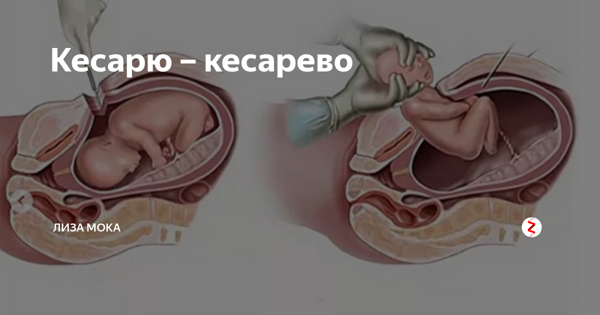 Операция кесарева сечения. Кесереро.