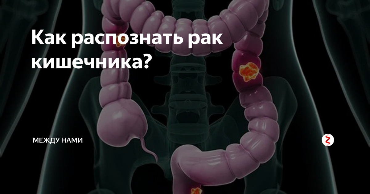 Запор - признаки, причины, симптомы, лечение и профилактика - iDoctor.kz